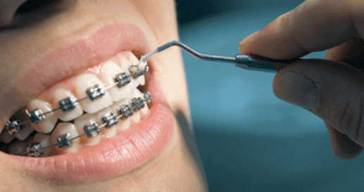 Interdental Brushes for Braces