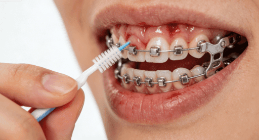 Interdental Brushes for Braces