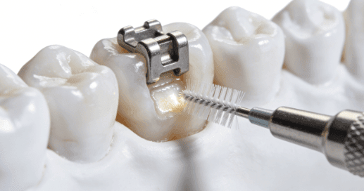Interdental Brushes for Braces