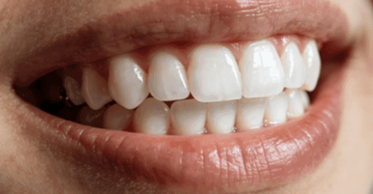 Interdental Brushes for Braces