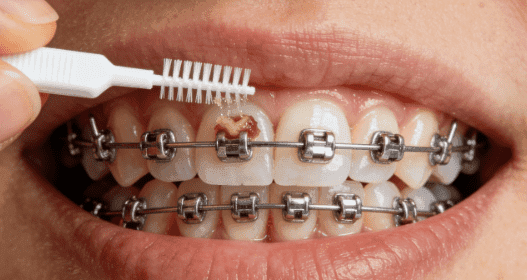 Braces Interdental Brush