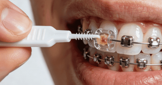 Braces Interdental Brush